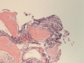MDS (cat, H&E)