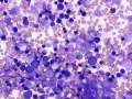 Myelodysplastic syndrome (MDS, cat)