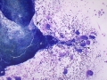 Megakaryocytic dysplasia (cat)