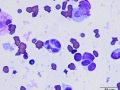 Dysplastic neutrophil (cat)