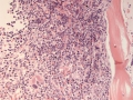MDS (cat, H&E)