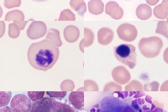 Dysplasia (VB)
