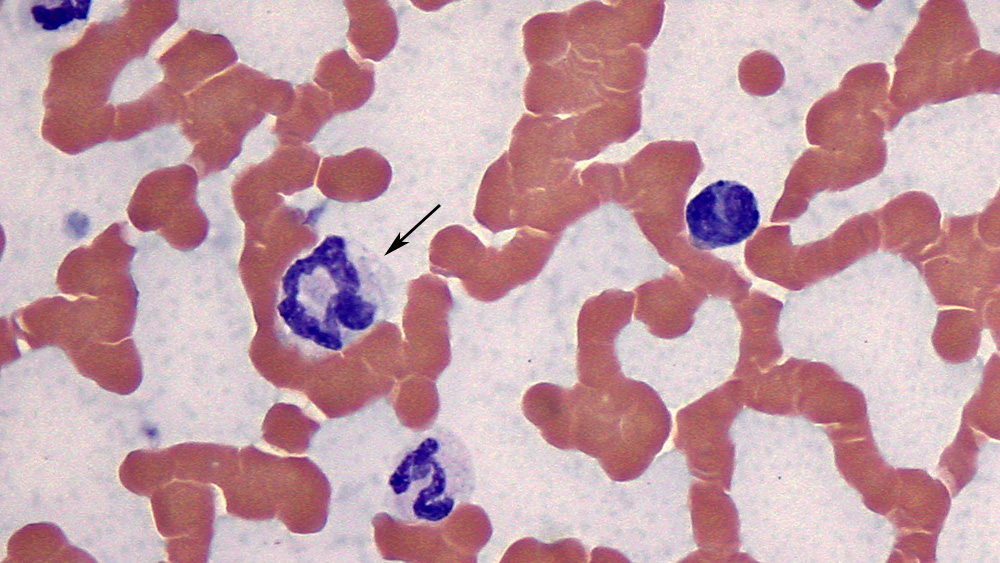Giant neutrophil (sepsis)
