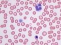 Dysplastic nRBC (vincristine)