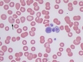 Siderocyte (vincristine)