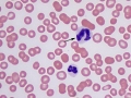 Dysplastic neutrophil (vincristine)