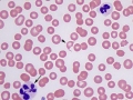 Dysplastic neutrophil (vincristine)