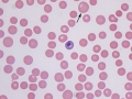 Dysplastic RBC (vincristine)