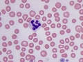 Dysplastic neutrophil (vincristine)