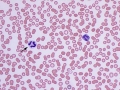 Dysplastic neutrophil (vincristine)
