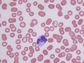 Dysplastic monocyte (vincristine)