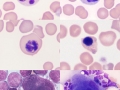 Dysplasia compilation (cat, leukemia)