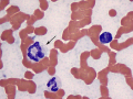 Giant neutrophil (sepsis)