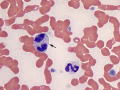 Pseudo-pelger huet (sepsis)