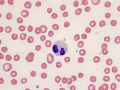 Pseudo-pelger huet (leukemia)