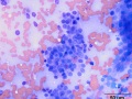 Apocrine gland adenocarcinoma
