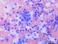 Apocrine gland adenocarcinoma