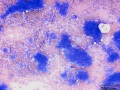 Apocrine gland adenocarcinoma