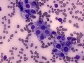 Chemodectoma