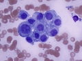 Chemodectoma