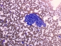 Chemodectoma