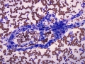 Chemodectoma (capillary)