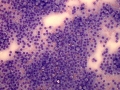 Thyroid C cell tumor (dog)