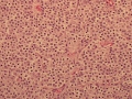 Thyroid C cell tumor (dog)
