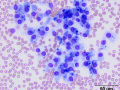 Thyroid carcinoma with tyrosine