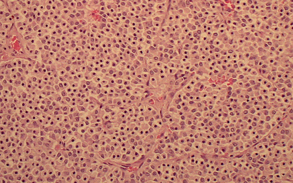 Thyroid C cell tumor (dog)