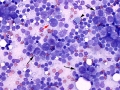 Metastatic carcinoma