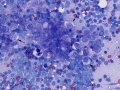 Metastatic carcinoma