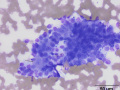 Perianal gland (hepatoid) epithelioma