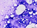 Squamous cell carcinoma
