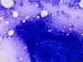 Squamous cell carcinoma