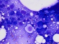 Squamous cell carcinoma