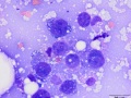 Squamous cell carcinoma