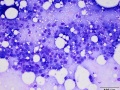 Squamous cell carcinoma