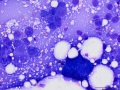 Squamous cell carcinoma
