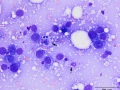 Squamous cell carcinoma