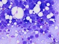 Squamous cell carcinoma