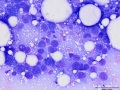 Squamous cell carcinoma
