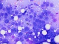 Squamous cell carcinoma