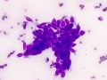 Trichoblastoma (spindled variant, cat)