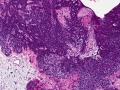 Trichoblastoma (dog, granular variant, H&E)