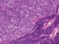 Trichoblastoma (dog, granular variant, H&E)