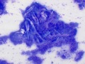 Trichoepithelioma