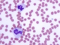 Marked leukocytosis