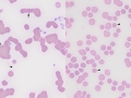 Immune-mediated hemolytic anemia