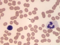 Neutrophil and lymphocyte